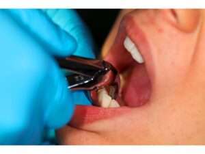 Doctor performing the Tooth Extractions
