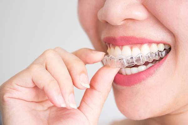 A women wearing transparent aligners on their teeth